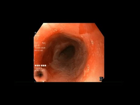 Rupture œsophagienne - endoscopie digestive haute