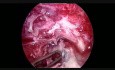 Fuite Gastrique Après une Gastrectomie Sleeve