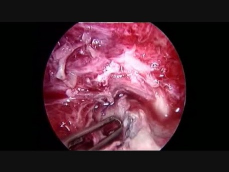 Fuite Gastrique Après une Gastrectomie Sleeve