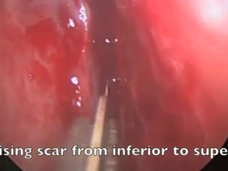 Cicatrices massives dans la cavité nasale - FESS