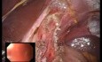 Myotomie de Heller et Fundoplicature Antérieure Laparo-Endoscopique à Site Unique (LESS)
