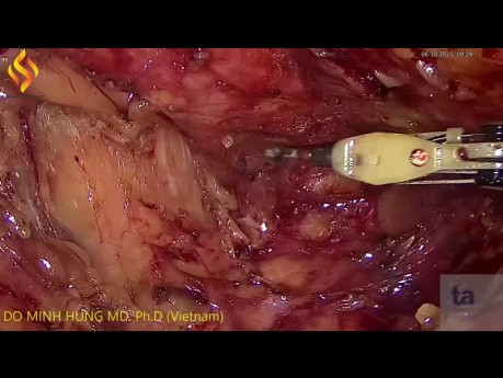 LAR pour le cancer rectal énorme