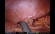 Utéroplastie-Sigmoïdo-Côlono-Vaginoplastie Robotique Totale : Restauration de la Foction Sexuelle et de Fertilité