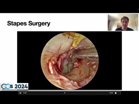 Comment Réaliser une Bonne Dissection de l'Oreille Moyenne. Conseils et Astuces.