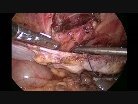 Prise en charge de la hernie spigélienne par voie laparoscopique
