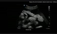 Stadification par ultrasons avec vidéos chirurgicales correspondantes et prédiction des risques de complications après une chirurgie du cancer de l'ovaire avancé