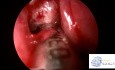 Sinusite Fongique Allergique – Chirurgie