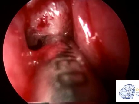 Sinusite Fongique Allergique – Chirurgie
