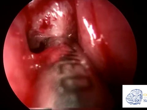 SINUSITE FUNGICA CIRURGIA