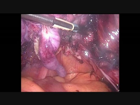 Hystérectomie totale avec salpingo-ovariectomie bilatérale par laparoscopie