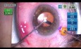 Technique de Pars Plana pour Glaucome Malin