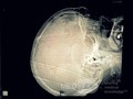 Hémorragie Sous-Durale Spontanée Aiguë dans l'espace sous-dural