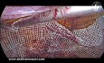 Réparation Laparoscopique d'une Hernie Inguinale par Filet Sans Tension
