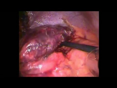 Hernie diaphragmatique avec fond gastrique nécrotique chez un patient avec un anneau gastrique converti en éventuelle gastrectomie longitudinale