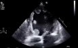 Petits Thrombi Endocardiques du Ventricule Gauche avec Dysfonctionnement Systolique Sévère du Ventricule Gauche