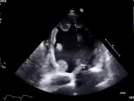 Petits Thrombi Endocardiques du Ventricule Gauche avec Dysfonctionnement Systolique Sévère du Ventricule Gauche