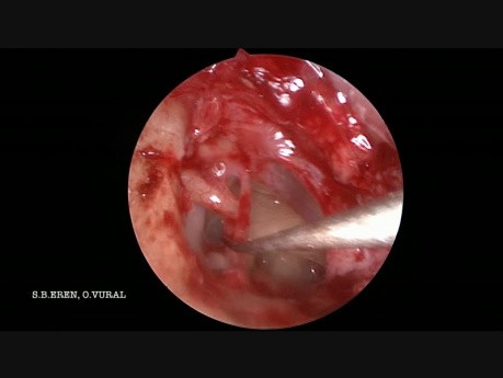 Stapédectomie par voie endoscopique.