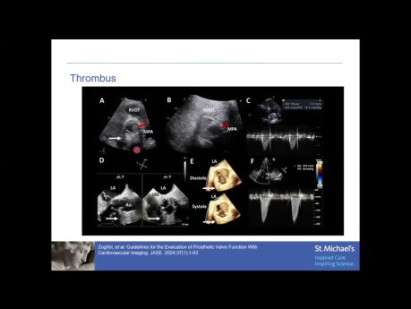 Évaluation Echocardiographique de la Fonction de la Prothèse Valvulaire Aortique 