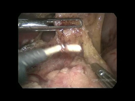 Gastrectomie subtotale par voie laparoscopique pour le cancer gastrique