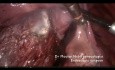 Myomectomie cervicale isthmique sur cicatrice abdominale