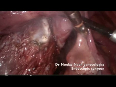Myomectomie cervicale isthmique sur cicatrice abdominale