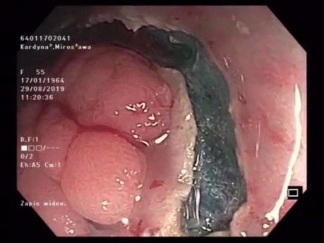 Mucosectomie/ Dissection Sous-Muqueuse Hybride