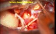 Tumeur Cérébrale- Schwannome du Trijumeau - Excision Microchirurgicale
