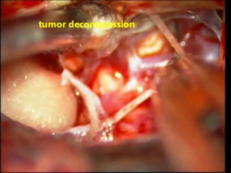 Tumeur Cérébrale- Schwannome du Trijumeau - Excision Microchirurgicale