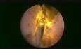 Enucléation de la prostate par laser Greenlight