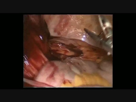 Traitement Laparoscopique d'un Volumineux Textilome Compliqué par une Inflammation de la Paroi Intestinale