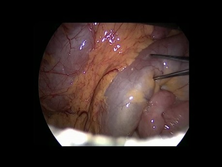 Résection du moignon après l'anastomose jéjuno-jéjunale chez un patient avec by-pass gastrique Roux-en-Y