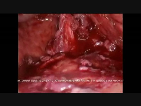 Cholécystectomie Laparoscopique chez un Patient avec de Calculs Biliaires et de Cirrhose Hépatique