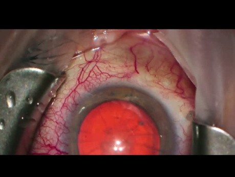 Chirurgie de la Cataracte par Tunnel Scléral pour Kératotomie Radiaire de cornée (RK)
