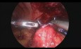 Ablation de la fistule ceacocutanée par voie laparoscopique (après appendicectomie)