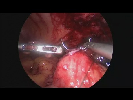 Ablation de la fistule ceacocutanée par voie laparoscopique (après appendicectomie)