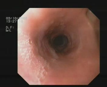 Diverticules Oesophagiens