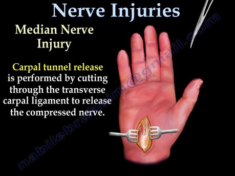 Syndrome du tunnel cubital et lésions nerveuses - vidéo d'enseignement