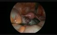 Torsion d'annexe - chirurgie laparoscopique