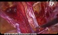 Réparation Laparoscopique d'une Hernie Inguinale Récidivante après Laparotomie Précédente