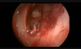 Polype sphénochoanal / cornet nasal supérieur / pulsation de la carotide interne