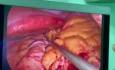 Gastrectomie Sleeve Mini-laparoscopique