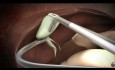 La Standardisation de la Cholécystectomie Laparo-Endoscopique à Site Unique (LESS)