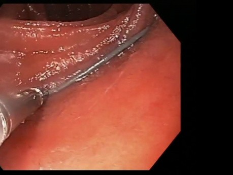 Événement indésirable en chirurgie bariatrique. Traitement endoscopique.