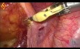 Résection antérieure haute du rectum et une tumorectomie hépatique par voie laparoscopique