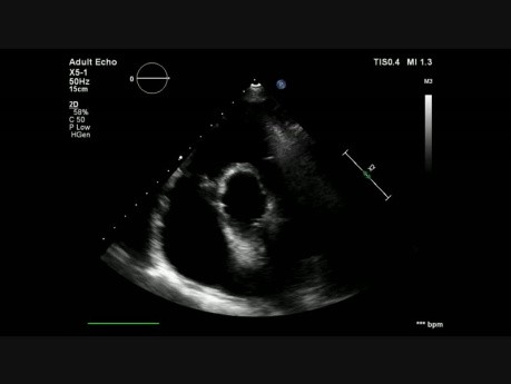 Endocardite infectieuse de la valve tricuspide