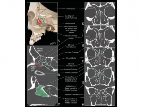 L'anatomie endoscopique de la paroi latérale de la fosse nasale