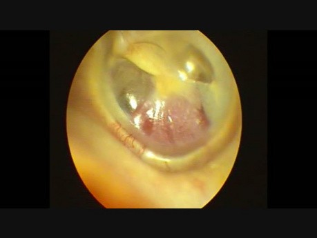 Tumeur glomique de l'oreille gauche
