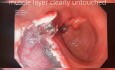 Lésion Antrale Dissection Sous-Muqueuse