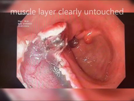 Lésion Antrale Dissection Sous-Muqueuse