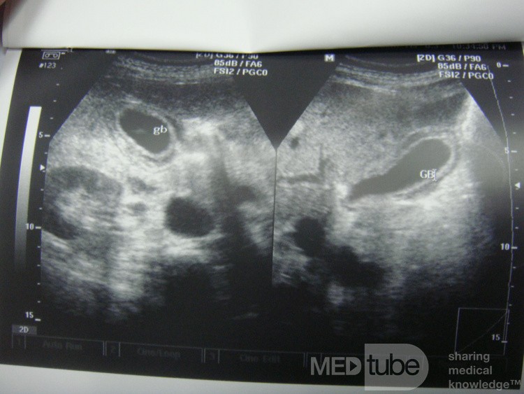 Echographie: Cholécystite aigue alithiasique